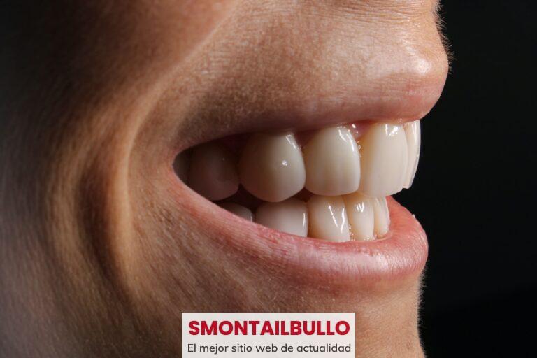 Las mejores carillas sin tallado